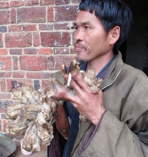 湖南44岁男子手脚长满木疙瘩，村医束手无策，医生说出了真相