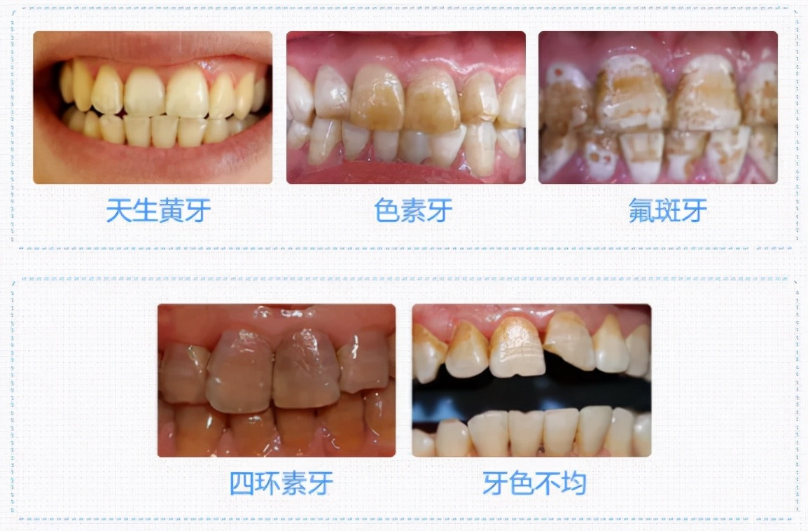 “抿嘴笑”“笑不漏齿”想要自信、灿烂、美丽笑容，做对这三步