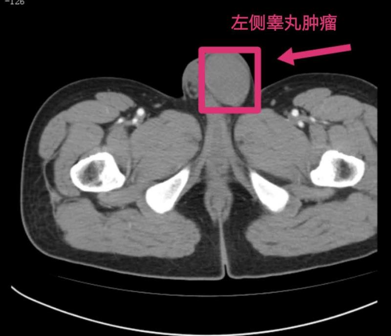 睾丸有癌,多能"摸出来"!不想手术切"蛋",请看此文