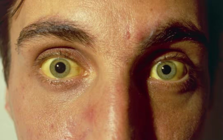 众所周知,乙肝是由于乙型肝炎病毒导致的疾病,具有传染性.