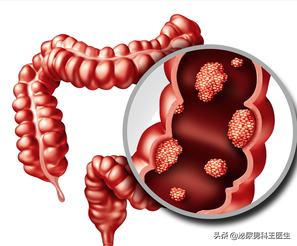 首先腸癌有結腸癌和直腸癌以及小腸癌之分,結直腸腺癌大約佔了全部結