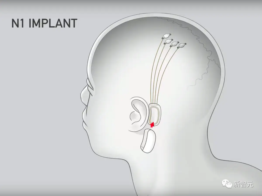 马斯克输麻了！美国首例脑机接口手术竟不是Neuralink做的
