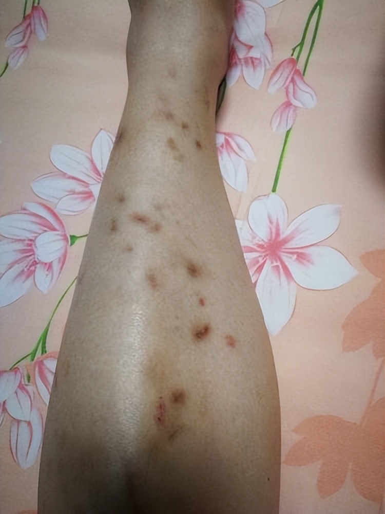 蚊子叮咬后留下的黑印如何清除?巨简单!赶快学起来