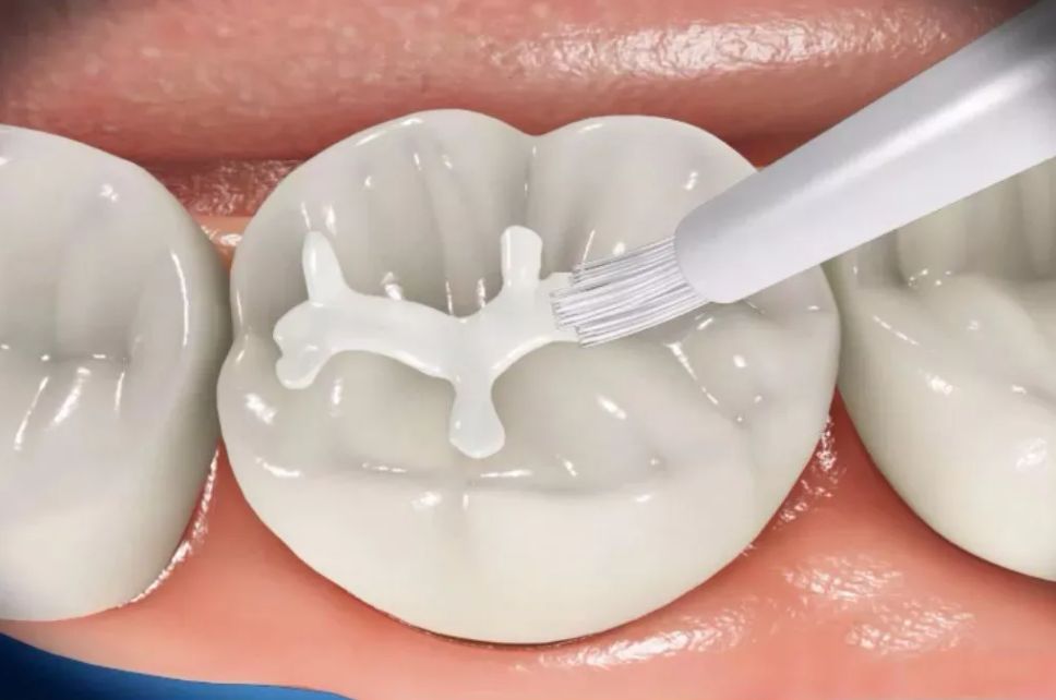 孩子"牙齿涂氟"为何那么流行?"窝沟封闭"要做吗?有无副作用