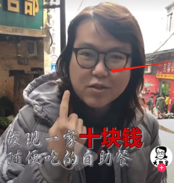 浪胃仙承认整容，双眼皮红肿蒜头鼻变挺拔，网友：像换了个头