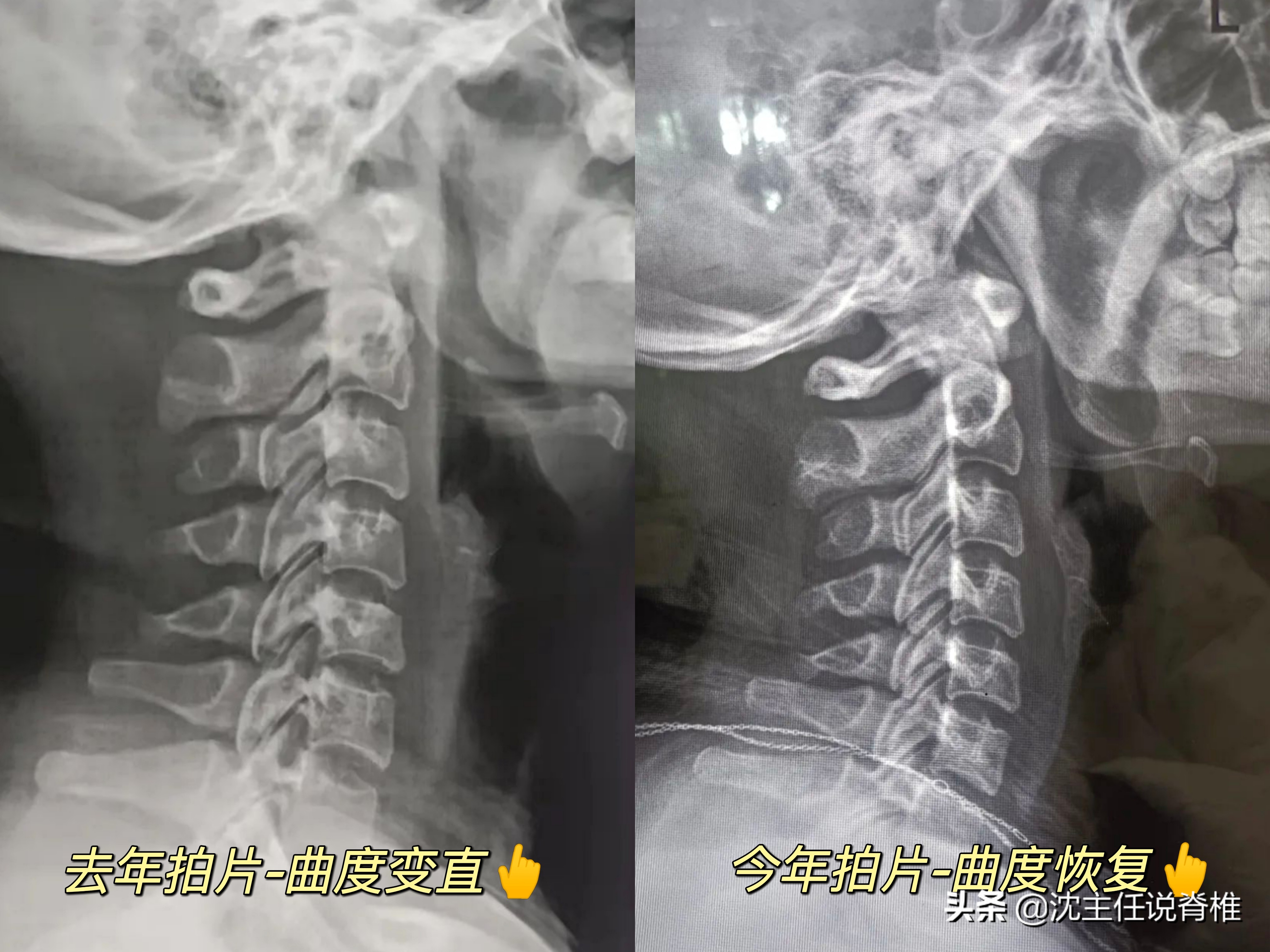 颈椎曲度变直怎么办？这位病人只做了2件事，一年后恢复正常