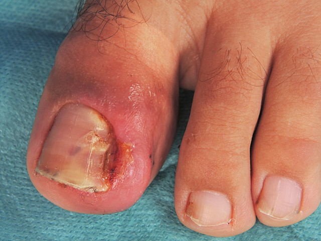 脚趾头细菌感染图片图片