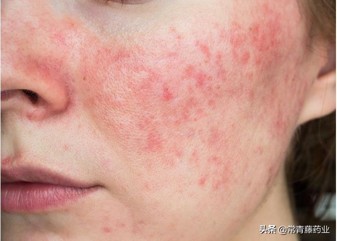 玫瑰痤疮早期图片(脸蛋容易泛红) - 赤虎壹号