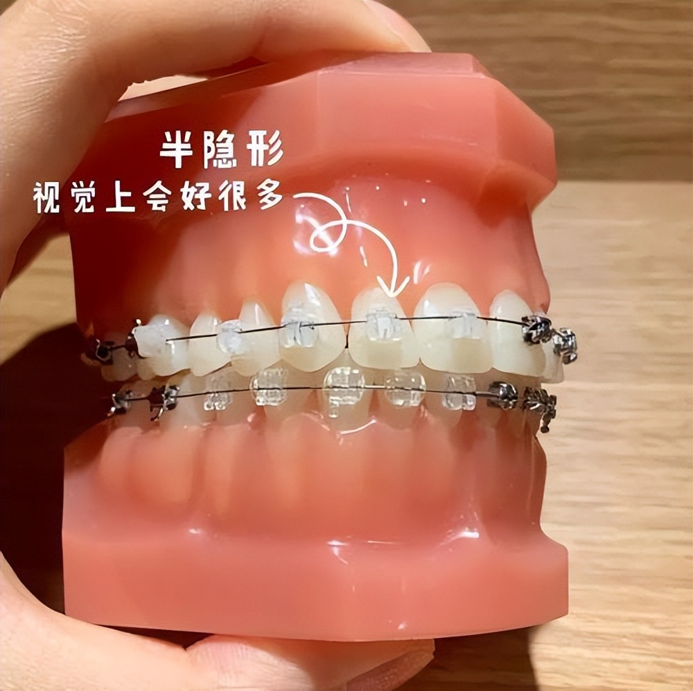 选适合自己的(价格,美观度,舒适度)常见的牙套有:普通托槽,自锁托槽