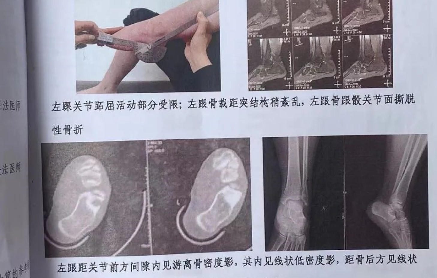 四川一“楼长”学姐查零食，13岁女生被罚150个下蹲，致终身残疾