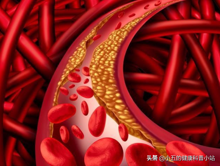 长期糖尿病引起血管损伤怎么办？合理使用4种药物，帮你保护血管