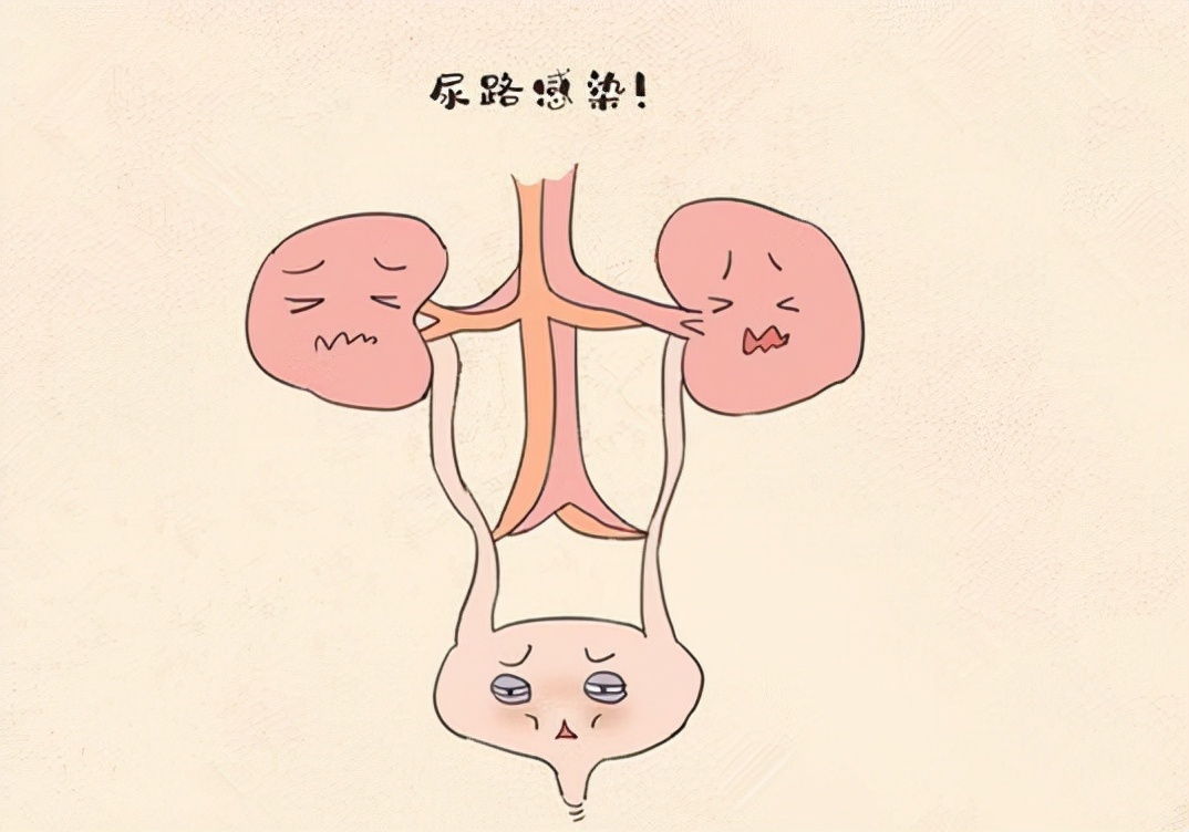同时又有尿频,尿急,尿痛,血尿,腰痛等症状时,很有可能是尿路感染,要