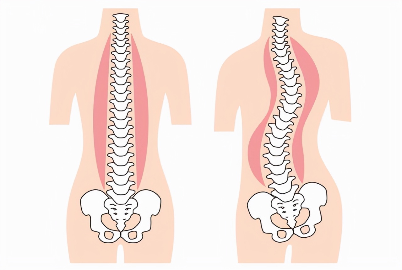 治疗脊柱侧弯花费近13万，能报销多少？6个问题，解答大家的疑惑
