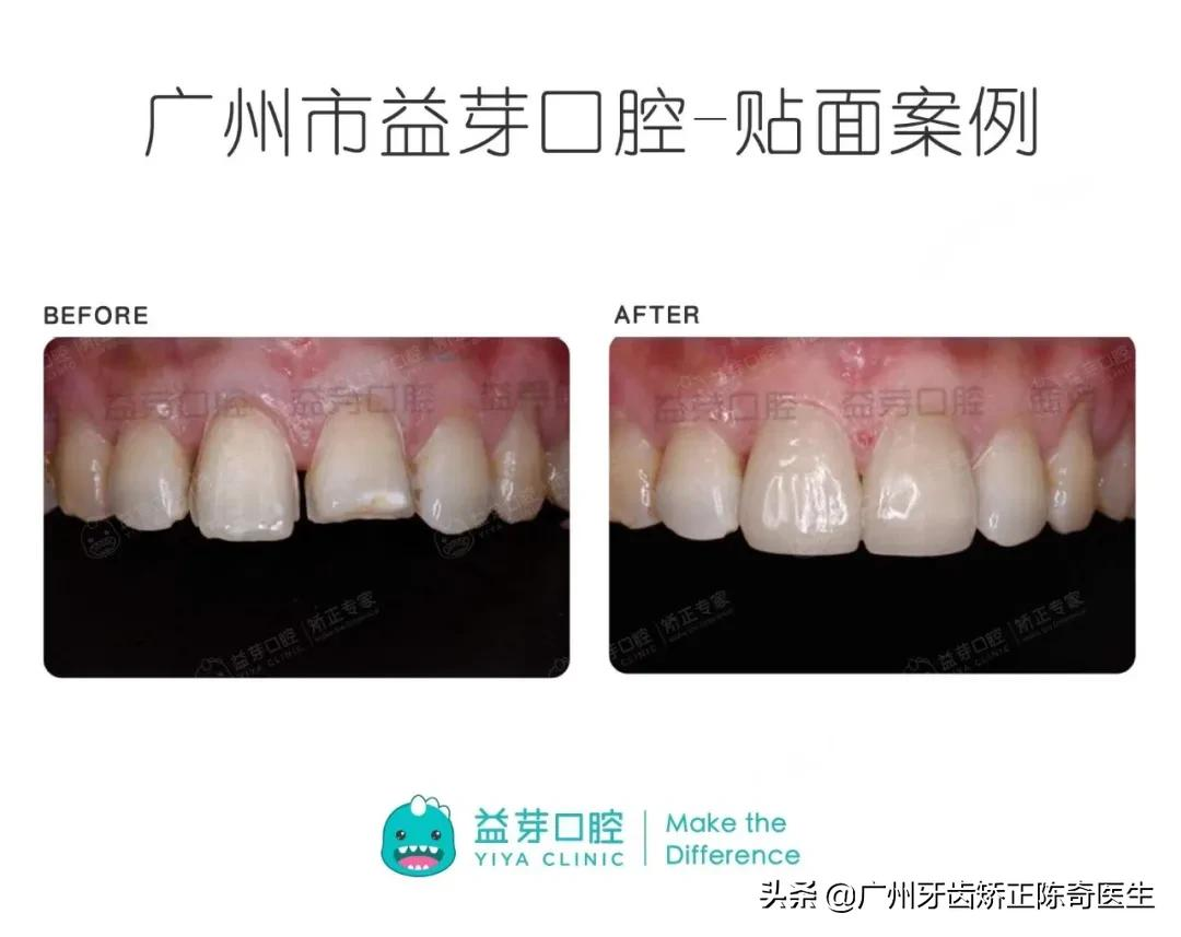 牙黄、牙缝大、牙齿缺损?明星们都在做的牙齿贴面了解一下