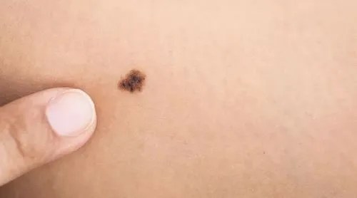 不是皮肤病，而是癌症信号？皮肤出现5种异样，警惕癌症来袭