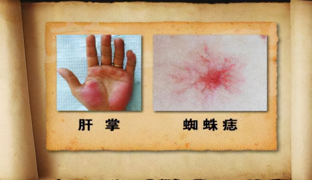 皮肤痒是肝不好？肝病引发的痒，可能还有3类皮肤表现，如何判断