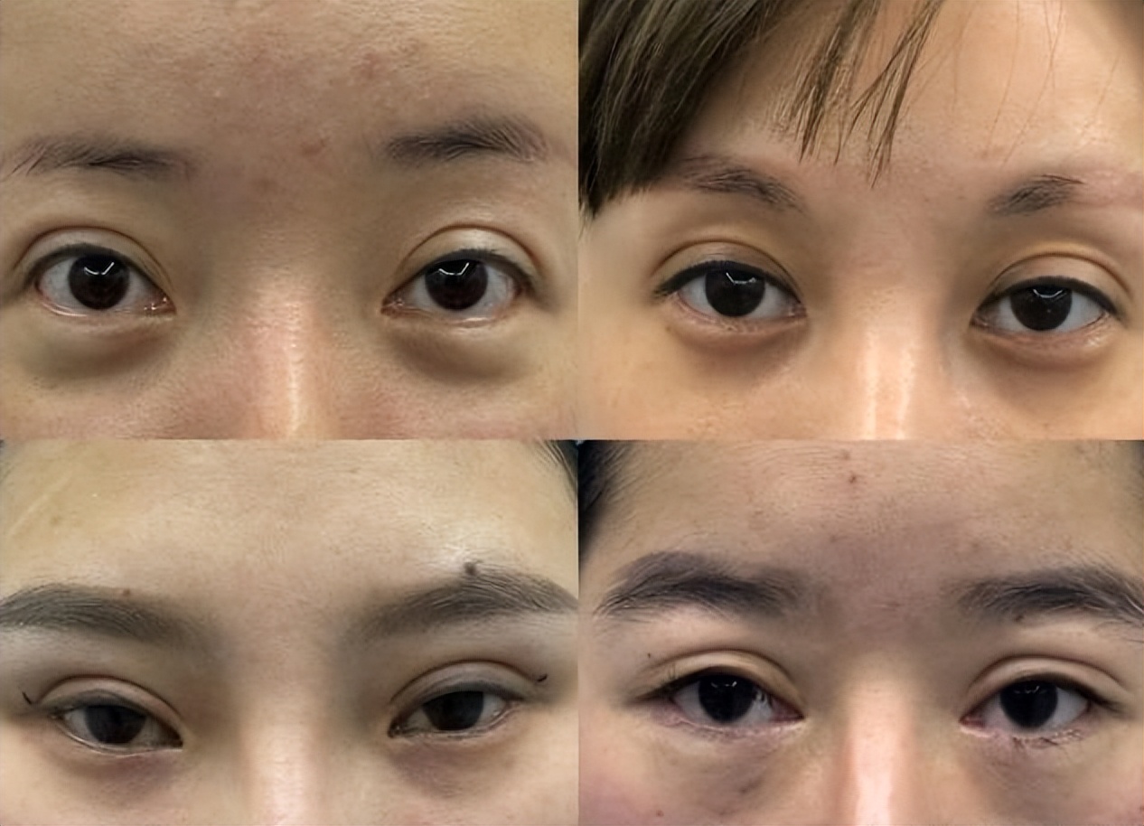 割双眼皮要多少钱 肿眼泡抽脂前后对照图-春风号