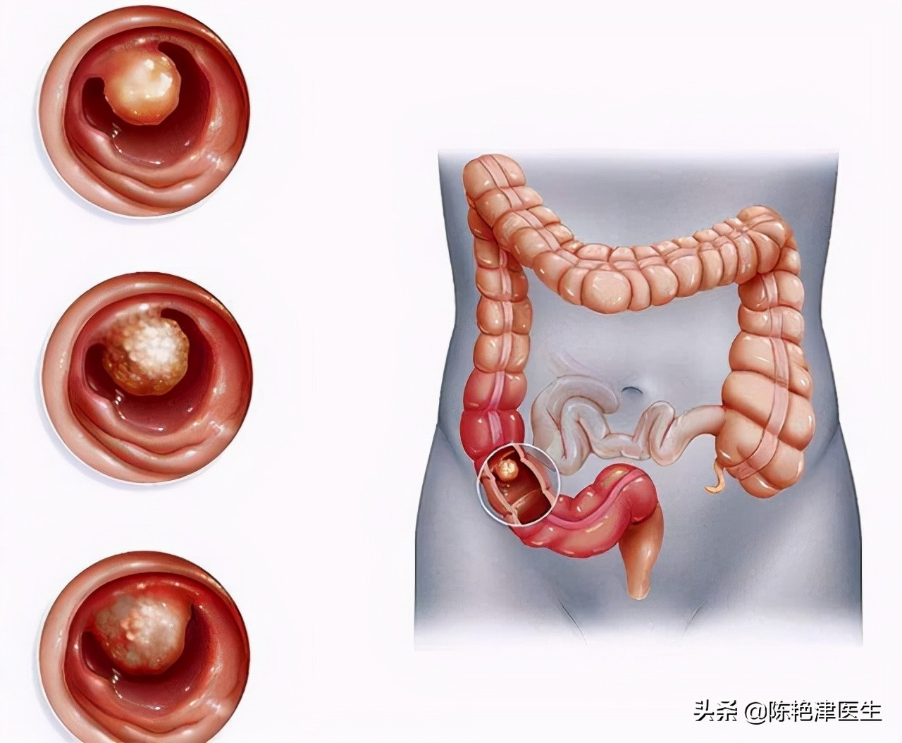 肠息肉是肠癌最大的祸根，如何不让息肉再生长？3件事要做好