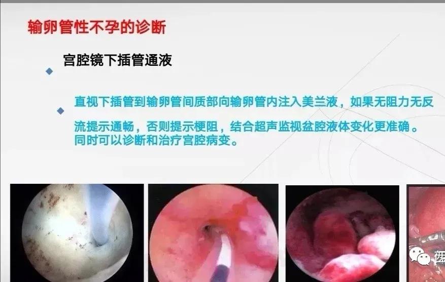 輸卵管造影大概費(fèi)用（輸卵管檢查需要多少錢？輸卵管檢查方法有哪些？）