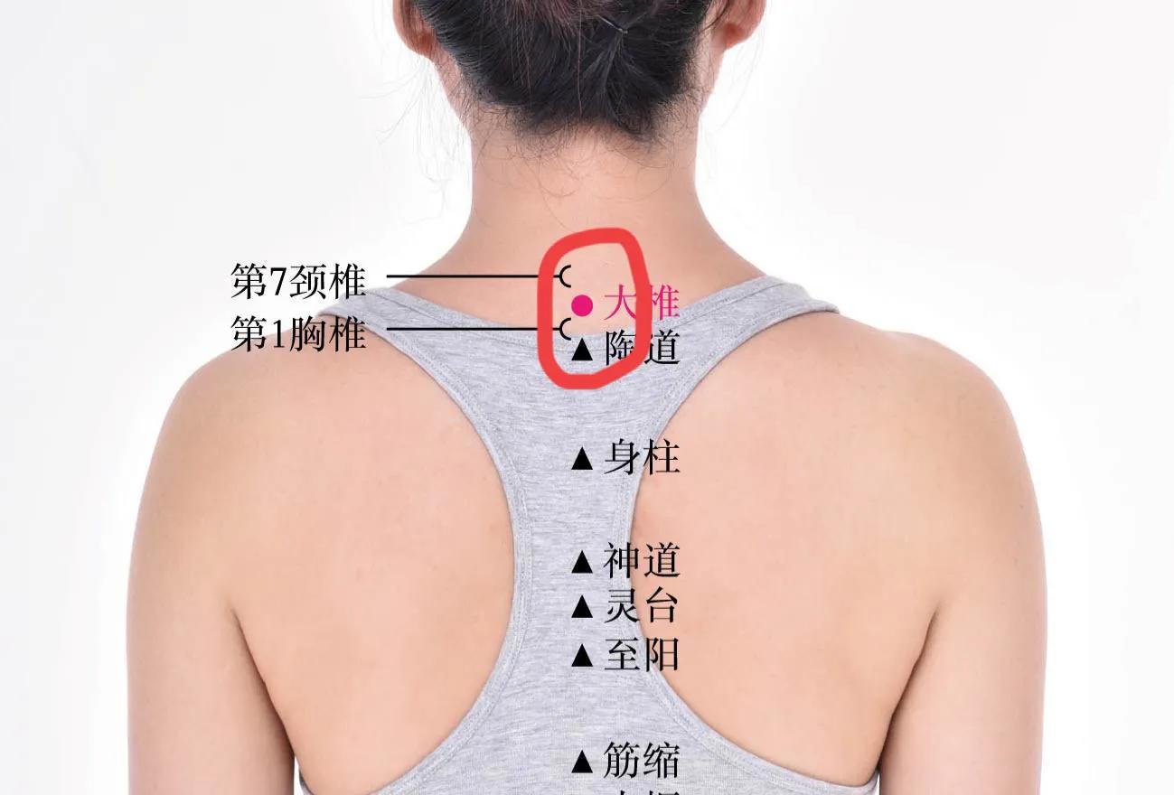 项背紧绷感、头晕的针灸治疗