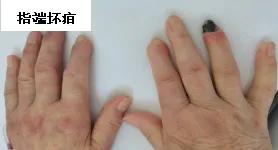 关节肿痛、皮疹… 这些可能是硬皮病 专题义诊活动等你来