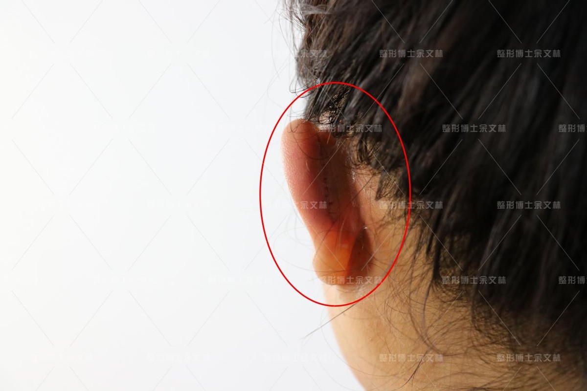 贴发耳矫正，可以注射玻尿酸吗？