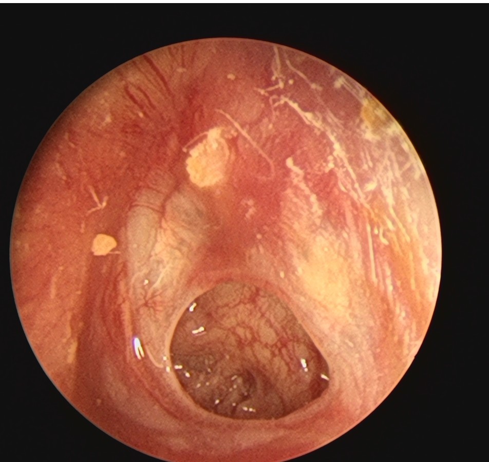 鼓膜穿孔手术 耳膜穿孔手术大概多少钱-千百号