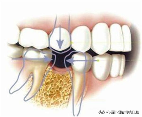 牙缝大是什么征兆？牙医：牙缝变大的主要原因、解决方法已整理好