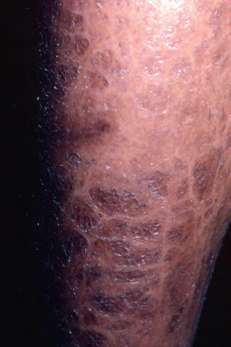 皮肤结节图片(结节病的皮肤改变)