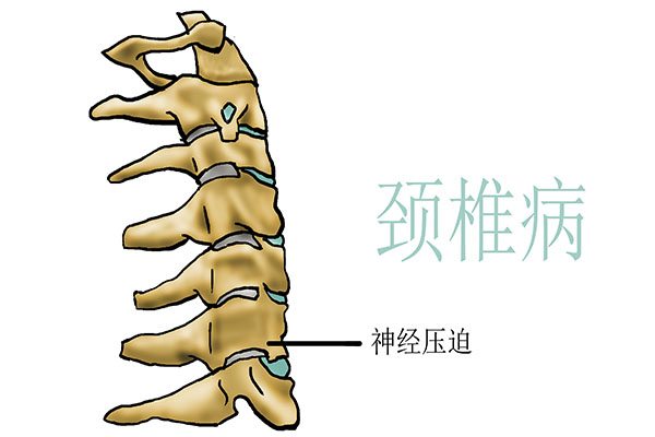 並不是!肩背疼痛和頸椎脫不了干係