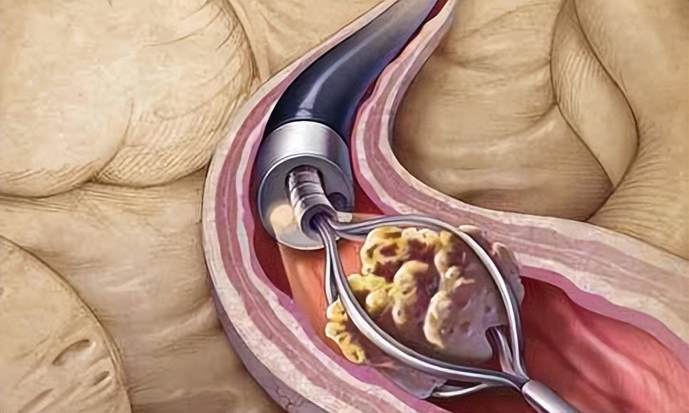 2,精囊结石:以血精,阴茎勃起疼痛感就诊,精液中有结石为主要症状,部分