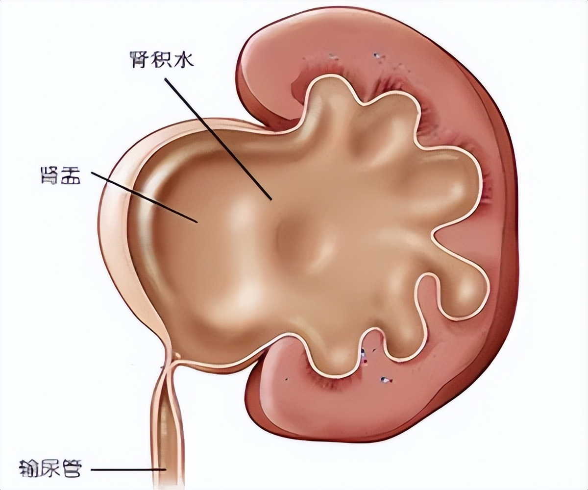 全身症狀可在腰部觸摸到腫塊,多見於腫瘤體積較大時.