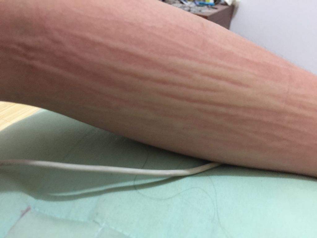 皮肤痒是肝不好？肝病引发的痒，可能还有3类皮肤表现，如何判断