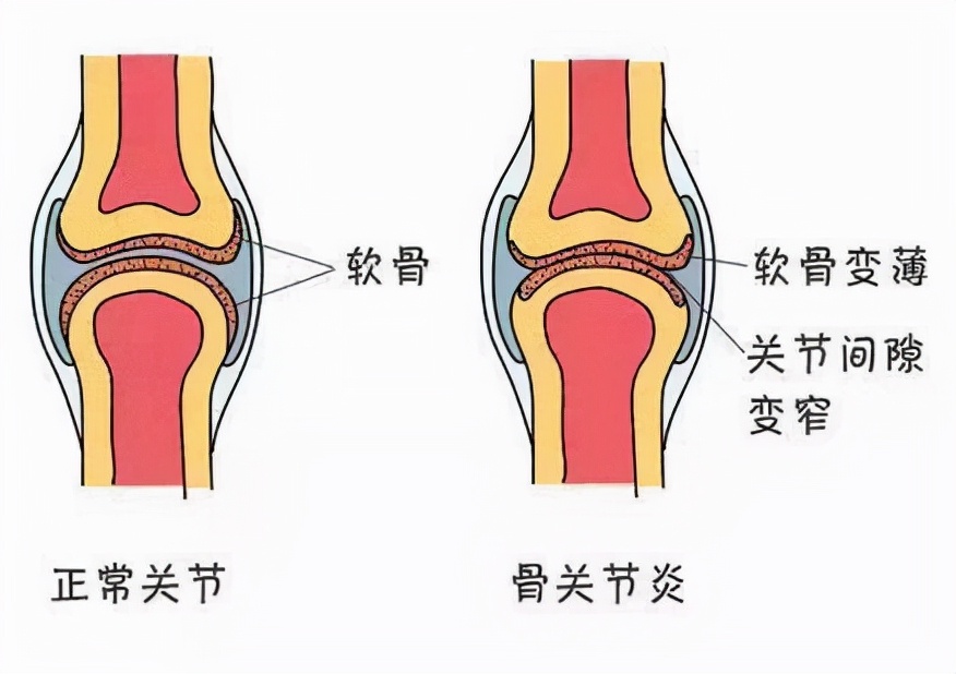 不死的癌癥：冬季高發(fā)的骨關(guān)節(jié)疾病