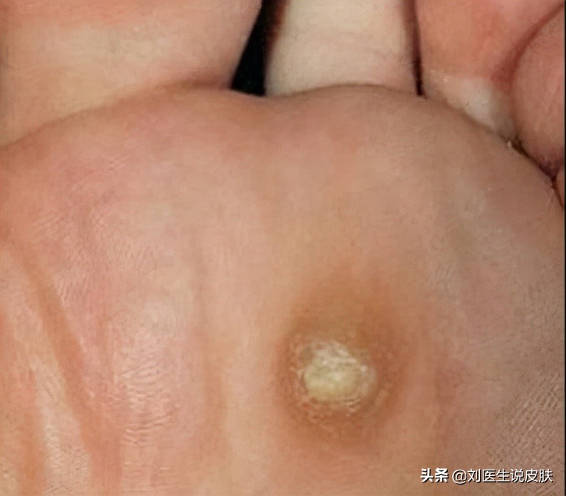 鸡眼vs跖疣,皮炎vs水痘,毛囊炎vs痤疮,这些皮肤病你能分辨吗?