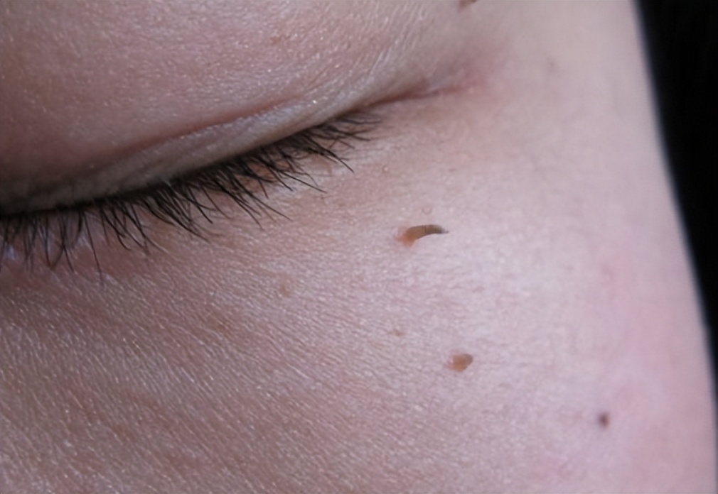 初期小疣体图片 疣体早期症状图片-春风号