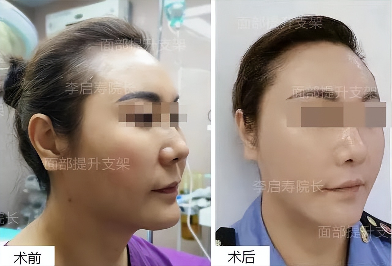 求美者问:面部支架提升,线雕,拉皮哪个更疼?