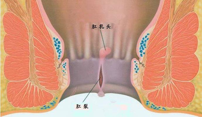 医生亲身和肛裂斗争的那些事