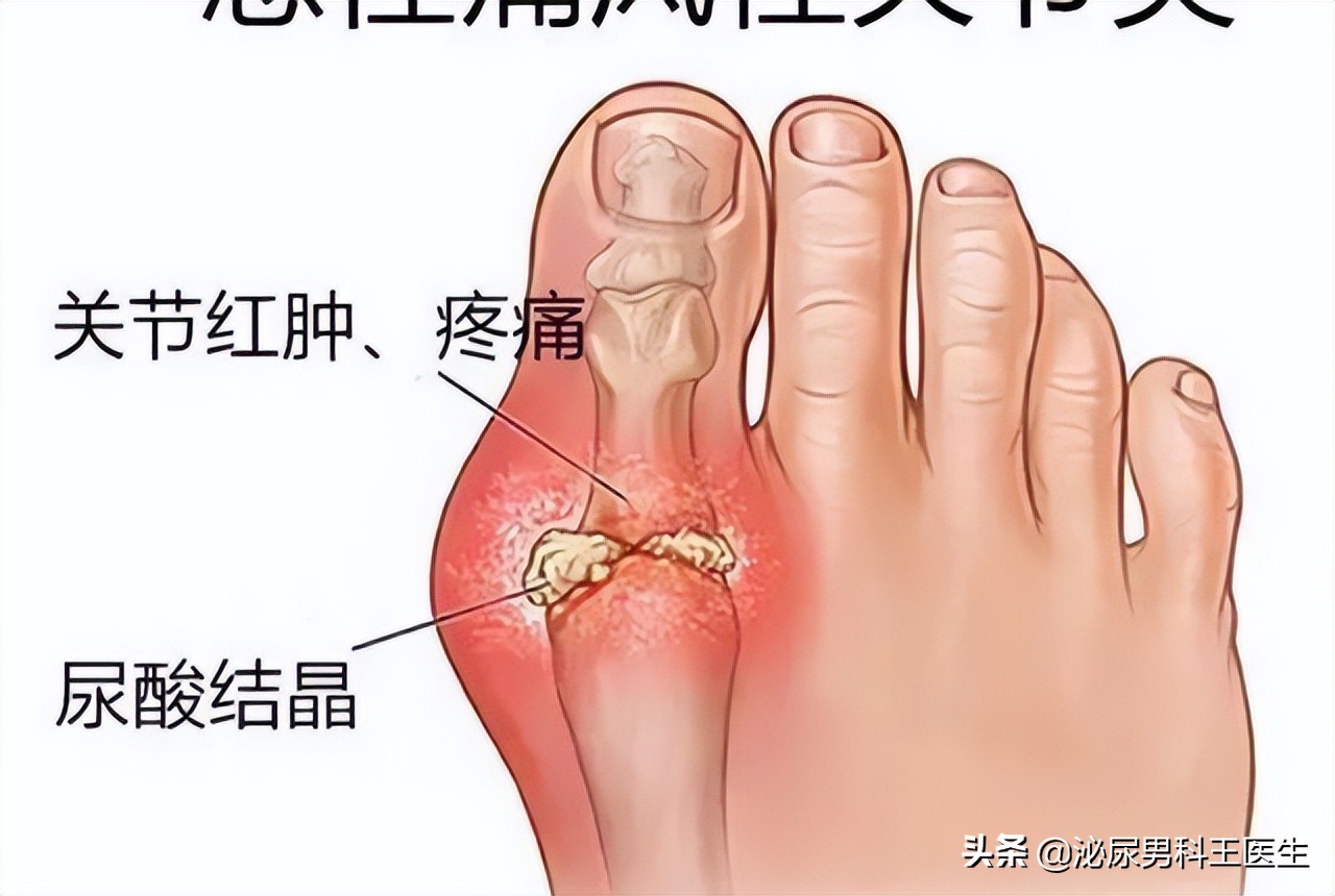 我国痛风高发，“祸根”是豆制品？其实这3种食物才是害人精