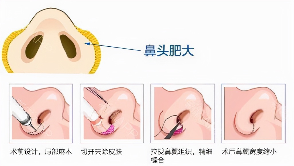 怎么让鼻翼缩小（自测你的鼻翼是否宽大？隆鼻时候一定要缩鼻翼？）