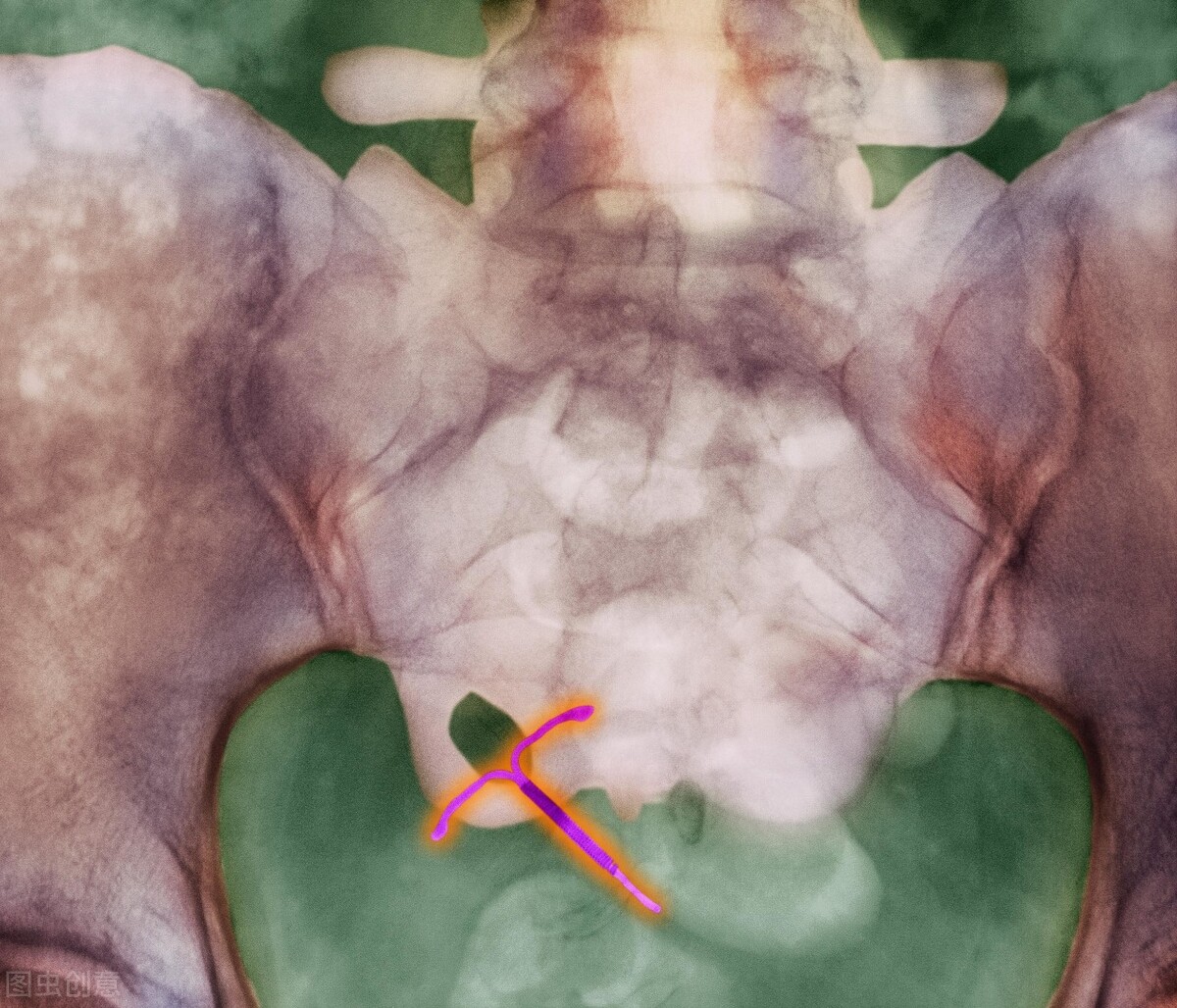 "残害一代中国女性"的节育环,今日我想为它说上几句公道话