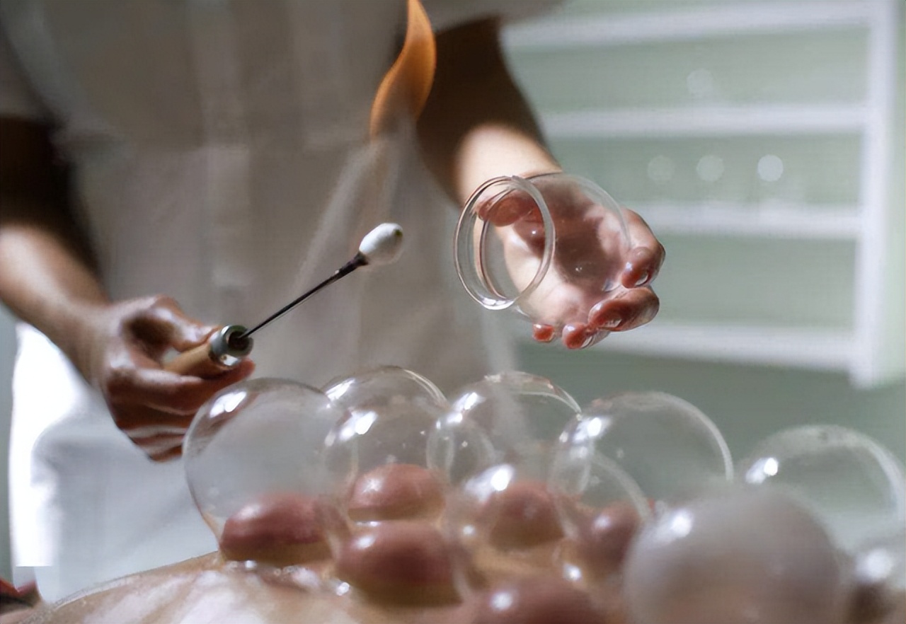 拔罐图片后背女(拔火罐时) - 赤虎壹号