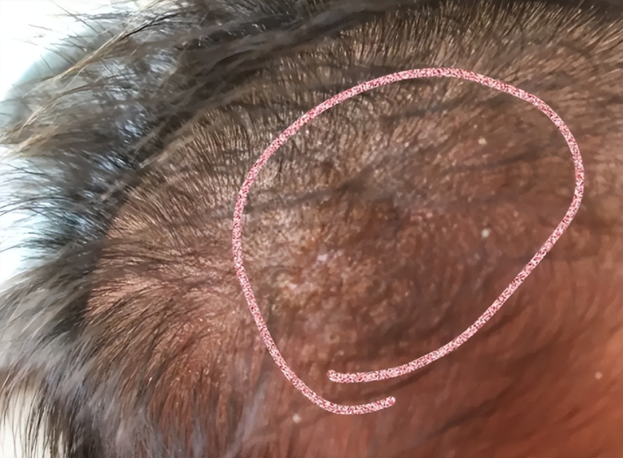 有一种"强迫症"是给宝宝抠乳痂,家长看上去爱干净,其实很坑娃