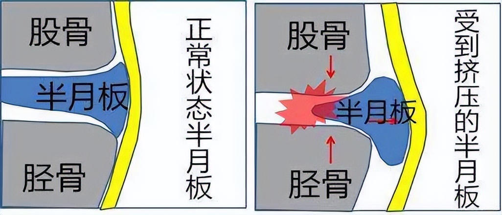 我打完篮球腿怎么很疼呢(蹲下时膝盖疼痛 | 6 个常见原因和简单的解决方案)