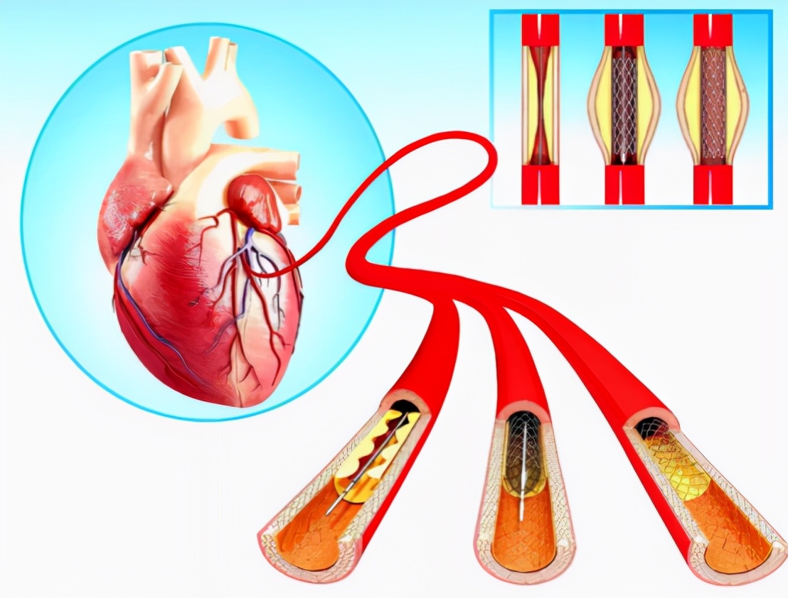 心脏支架图片位置图片