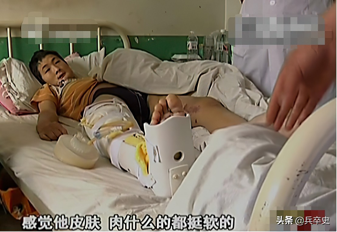 真实故事：山东17岁男孩无痛感汗腺，自我伤害博痛觉，父母泪崩