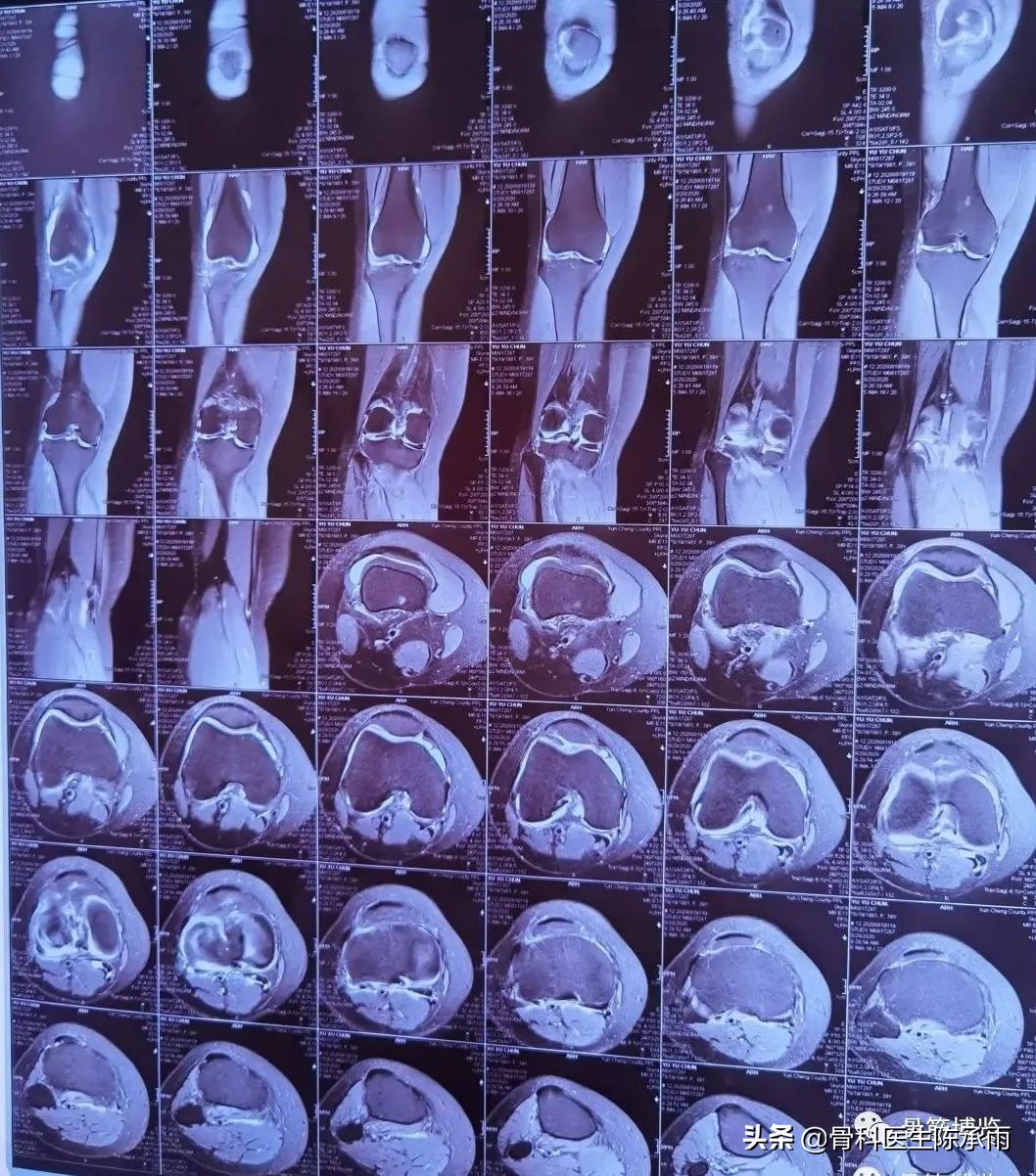 半月板损伤可以打保骨针(1例半月板全切的思考——如何才能更有效的