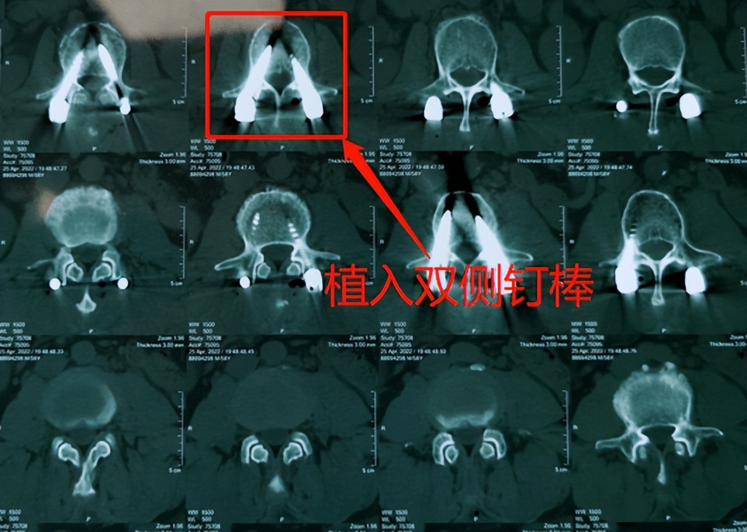 腰椎内固定手术让58岁工人重新挺直腰杆