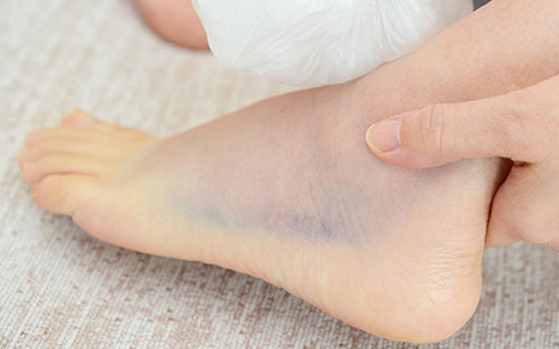 崴脚分三种,怎样进行分辨,要休息多长时间?听听医生怎么说