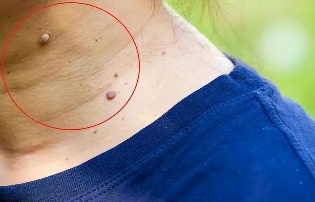 乳晕边上长了小肉粒图片(脖子) - 赤虎壹号